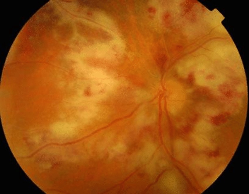 CMV retinitis فرد مبتلا به ایدز