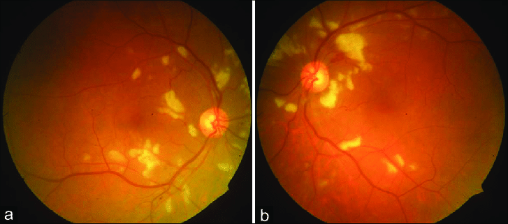  HIV retinopathy رتینوپاتی چشم مبتلا به ایدز