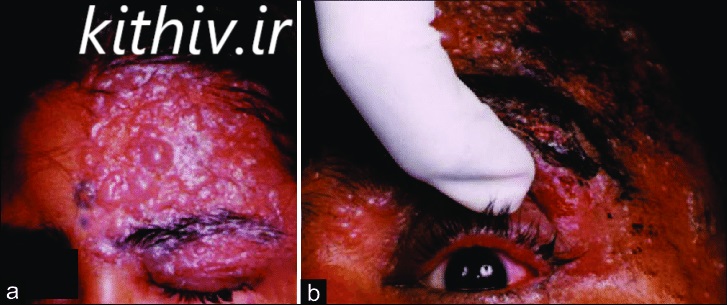 Herpes zoster ophthalmicus (HZO) فرد مبتلا به HIV