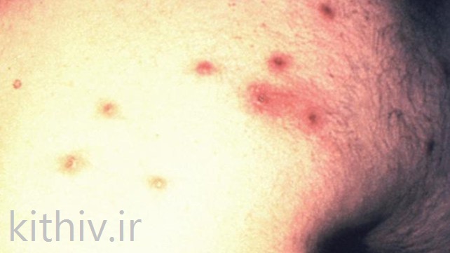 راش پوستی ایدز 3