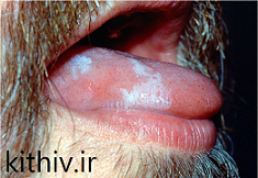 لوکوپلاکیای مویی دهانی در ایدز 1
