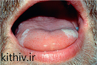 لوکوپلاکیای مویی دهانی در ایدز 2