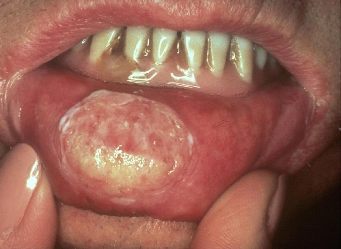 ایدز از طریق دهان