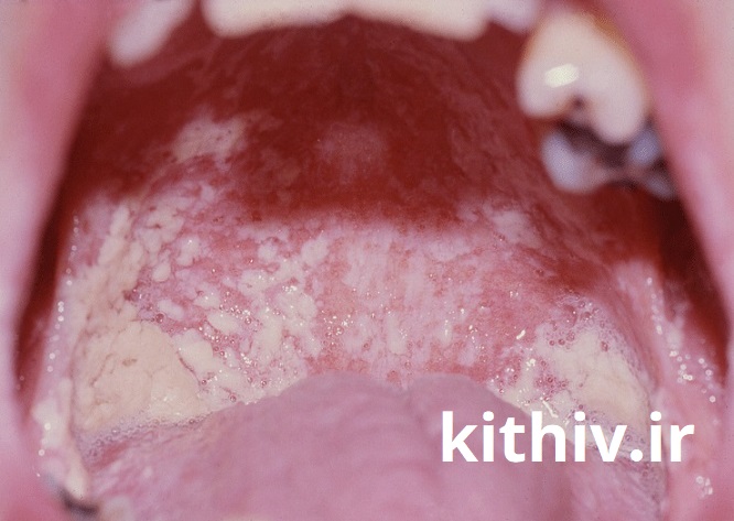 تصویر 3 برفک دهانی فرد مبتلا به ایدز