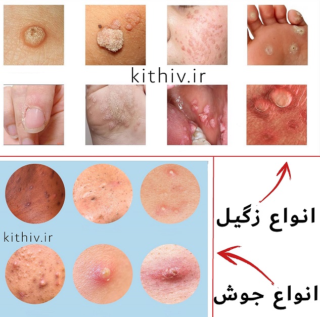از کجا بفهمیم زگیل تناسلی داریم یا جوش + رفع زود انزالی فوری + پرده بکارت