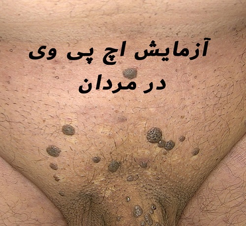 آزمایش HPV در مردان چگونه انجام می‌شود