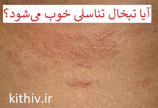 آیا تبخال تناسلی خوب می‌شود