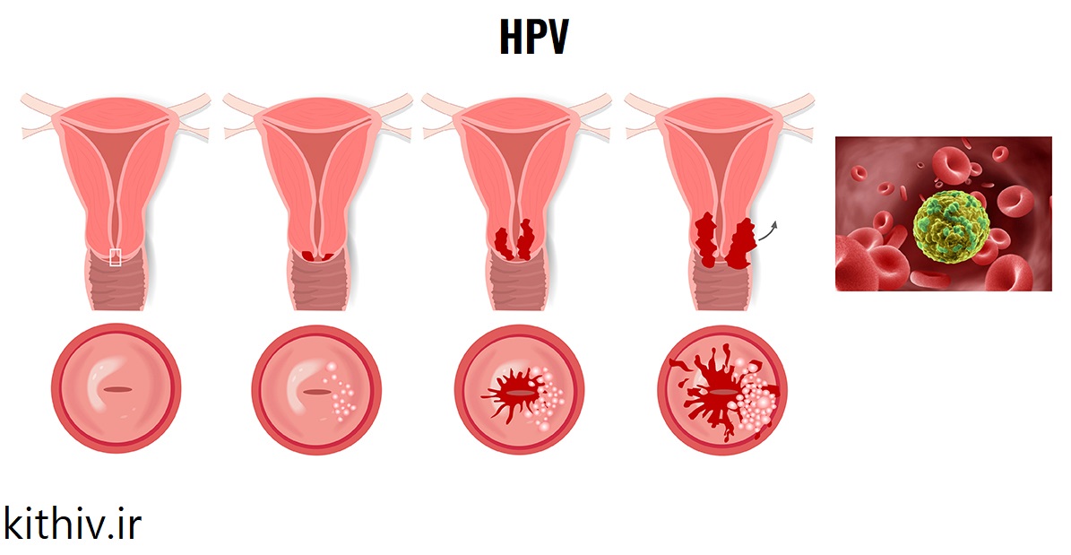 HPV بدخیم