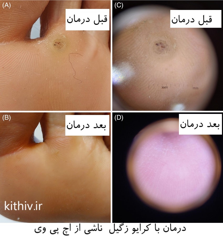 درمان اچ پی وی زگیل تناسلی با سرما کرایو