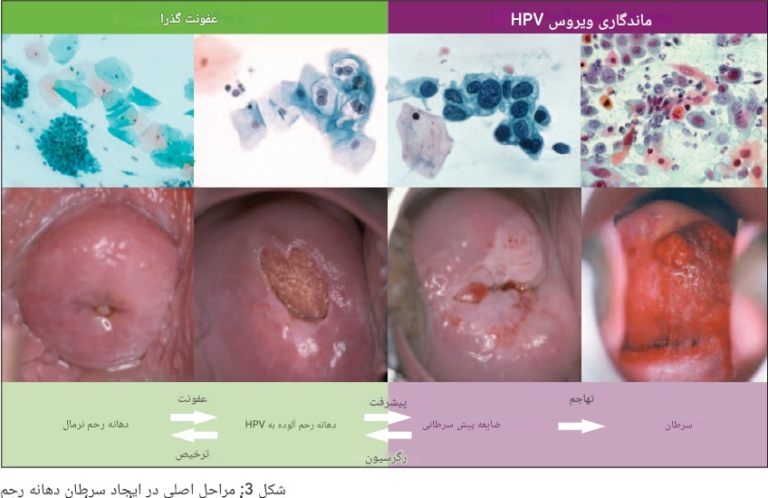 زگیل تناسلی در زنان