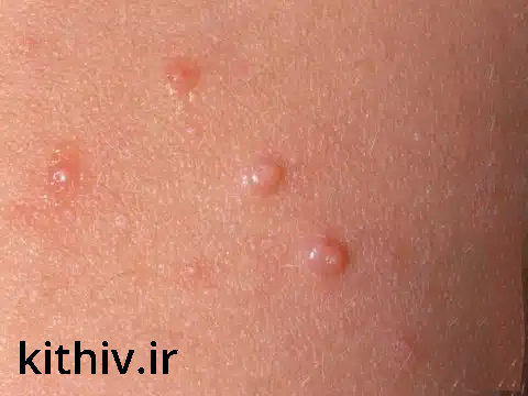 hpv