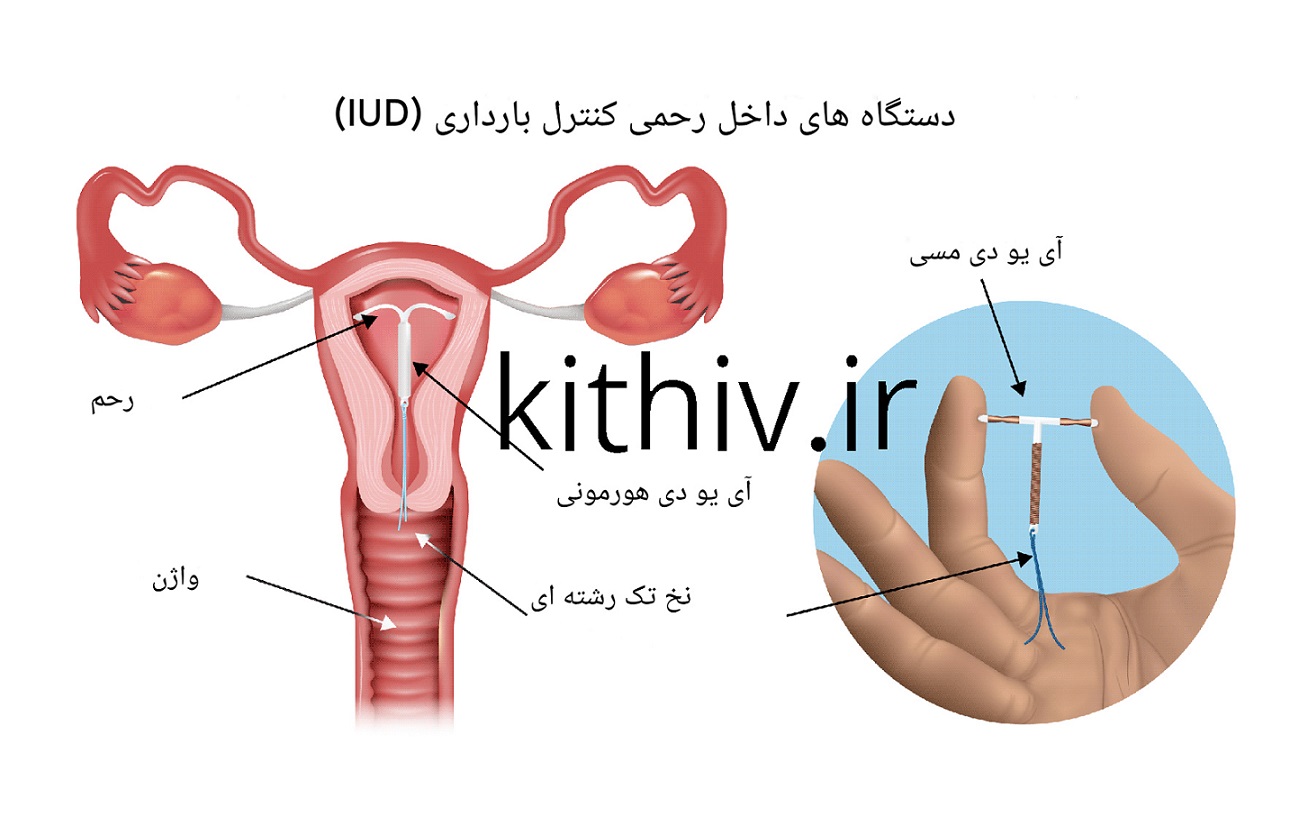 IUDs