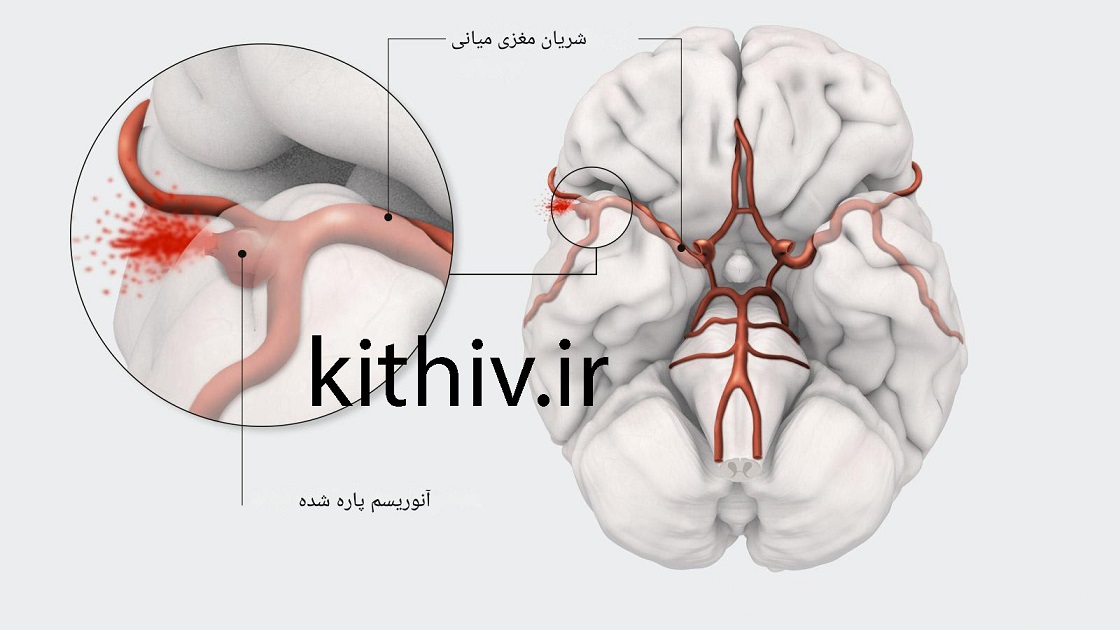 خونریزی زیرعنکبوتیه