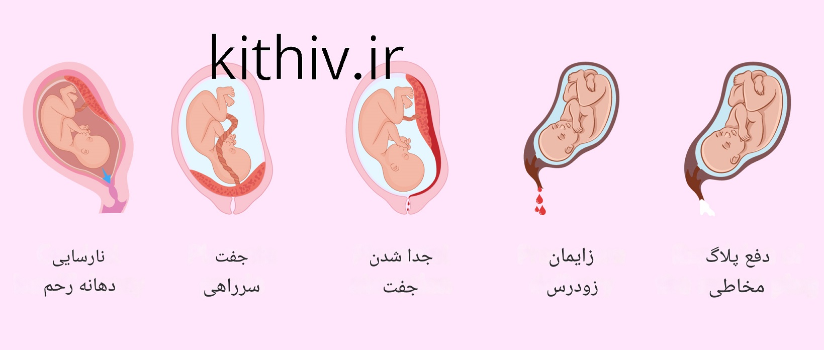 علل خونریزی در سه ماهه دوم و سوم بارداری