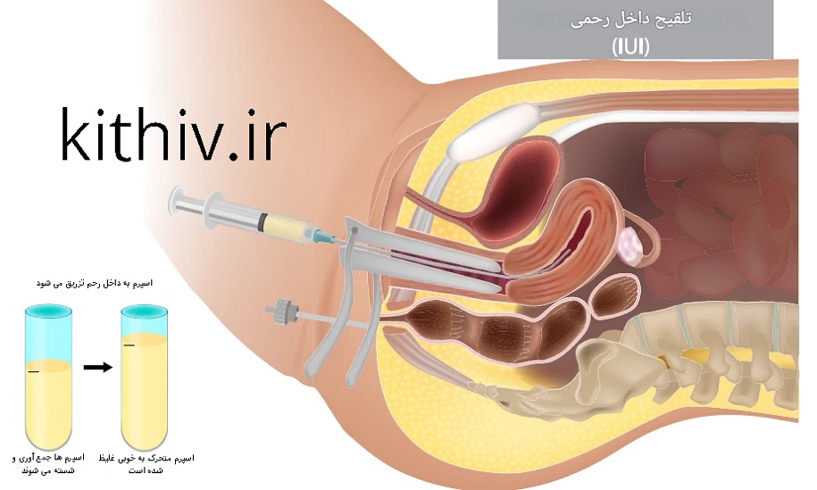 تلقیح داخل رحمی IUI