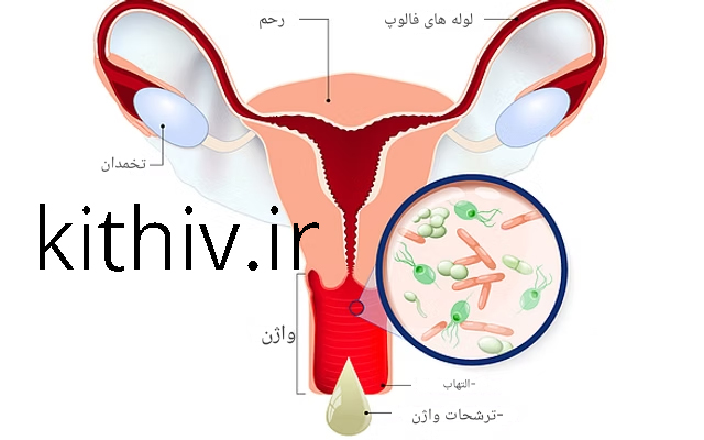 عفونت مکرر واژن