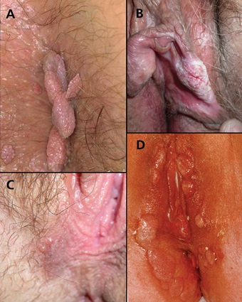 عکس زگیل تناسلی 52 - هر چیز برآمده ای در ناحیه تناسلی زگیل و HPV نیست.