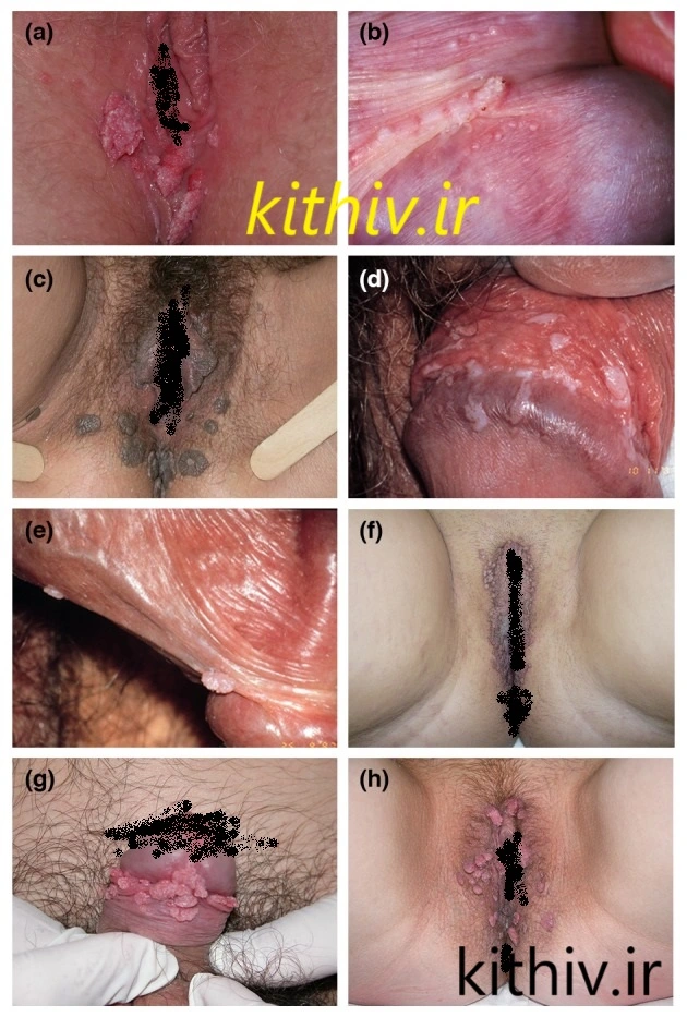 عکس زگیل تناسلی در مردان و زنان 1
