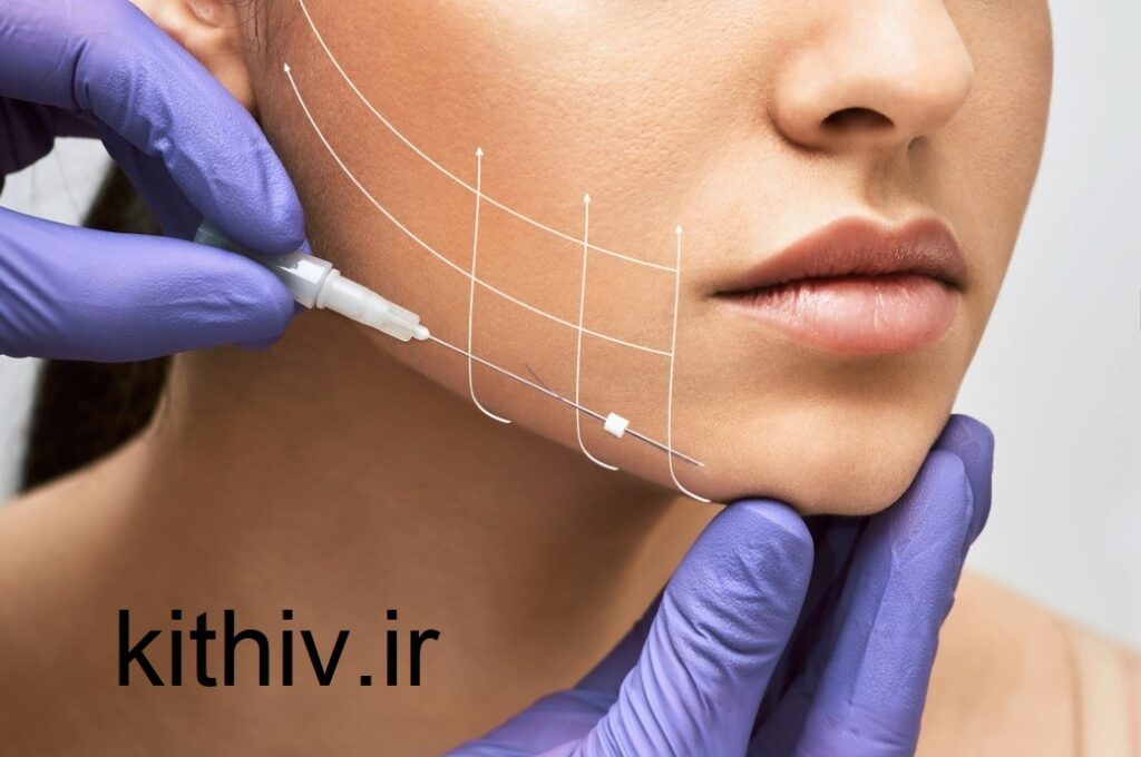 Thread face lift