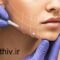 Thread face lift