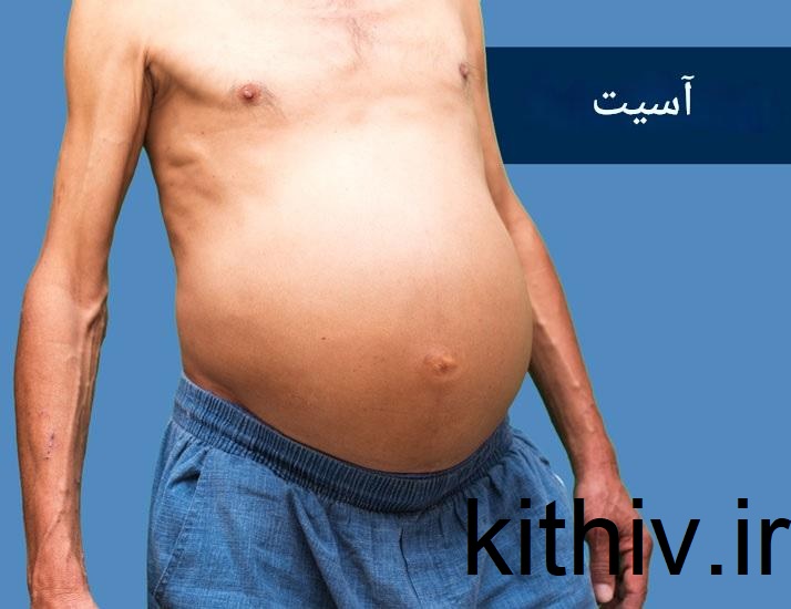 آیا هپاتیت اتوایمیون خطرناک است