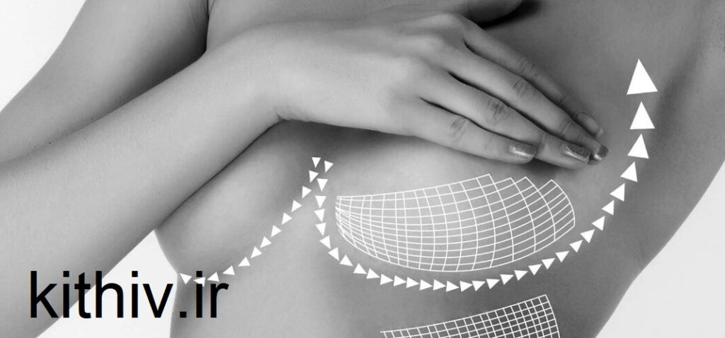 Breast lift