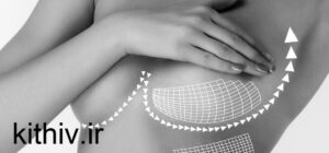 Breast lift