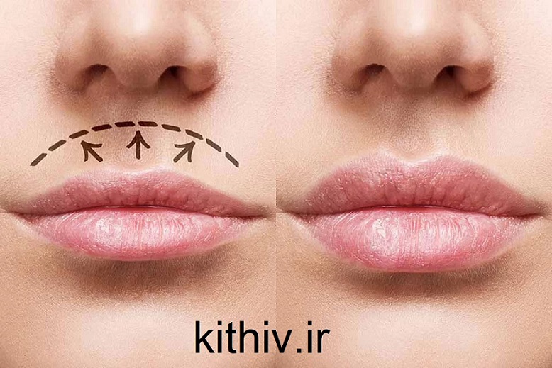 Central lip lift