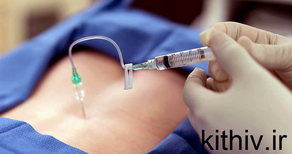 تزریق ژل برای دیسک کمر