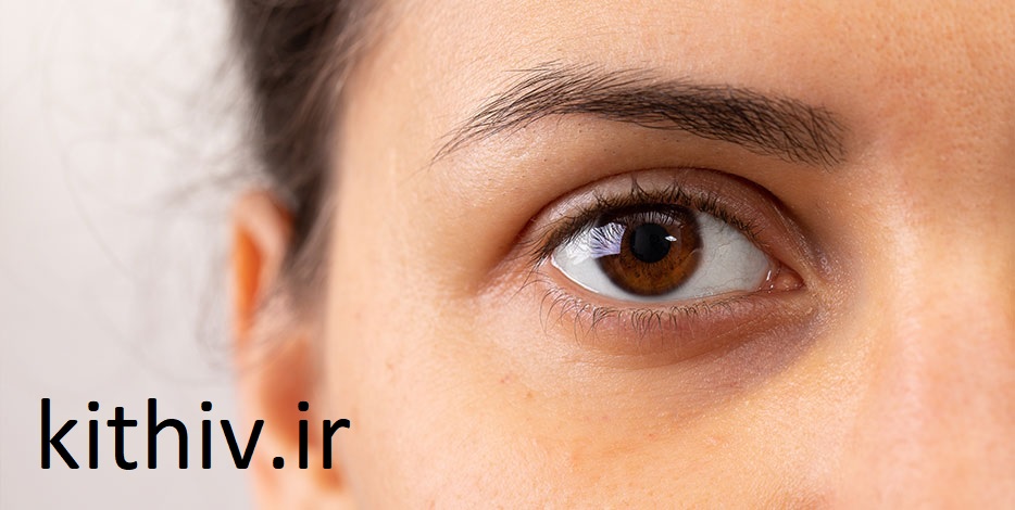 تزریق ژل زیر چشم