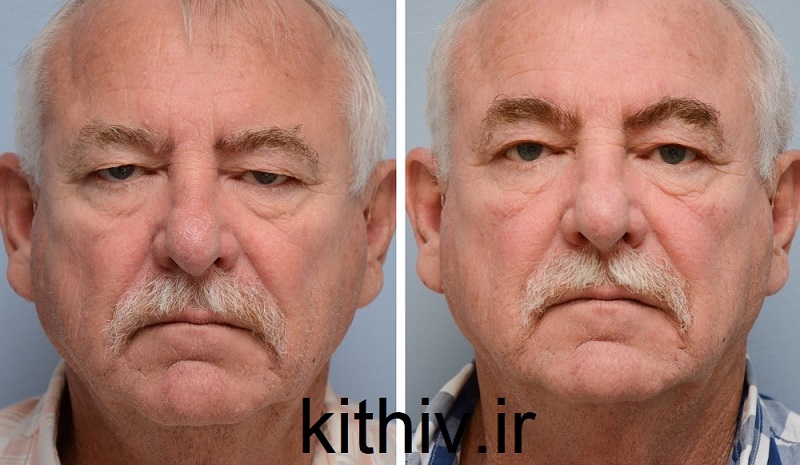 لیفت پیشانی