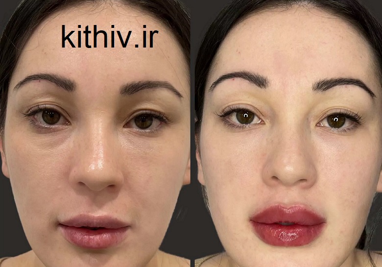 تزریق ژل لب روسی