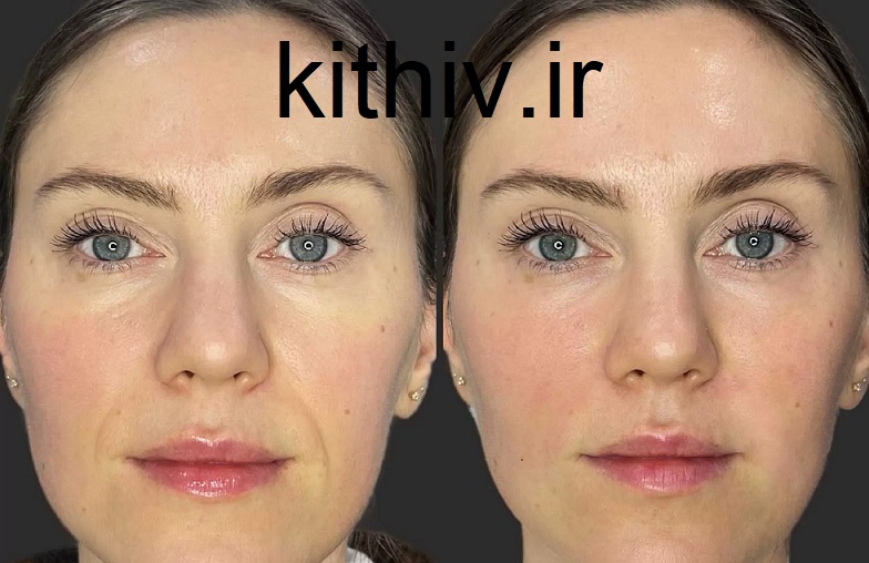 تزریق ژل برای خط خنده
