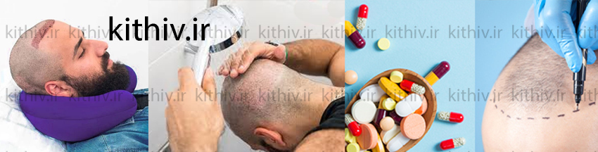 مراقبت های لازم بعد از کاشت مو