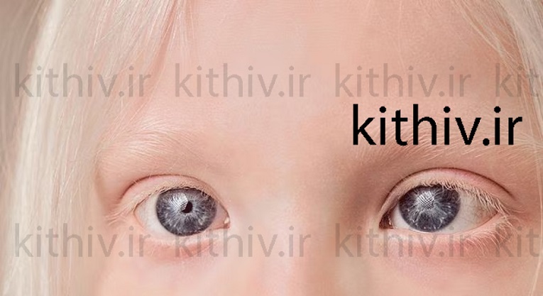 آلبینیسم