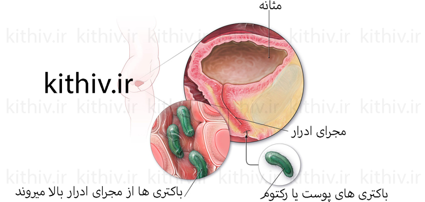 عفونت مجاری ادرار