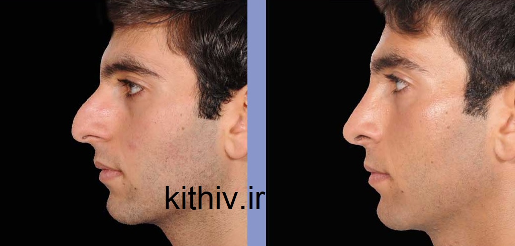 عمل بینی مردانه