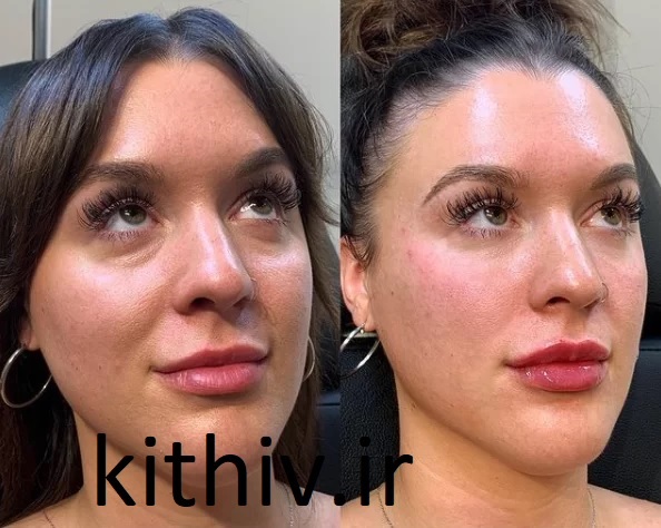 تزریق ژل زیر چشم