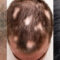 Alopecia