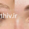 Eyebrow transplantation