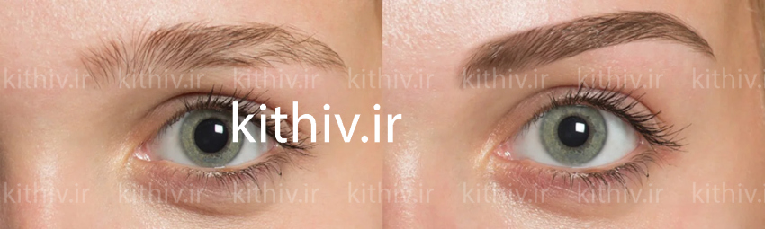 Eyebrow transplantation