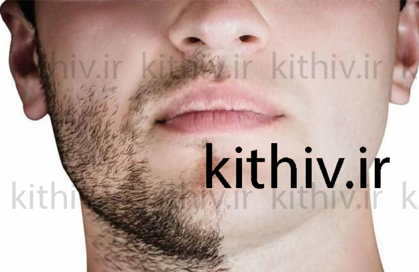Facial beard transplant