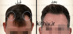 Hair transplant