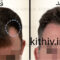 Hair transplant