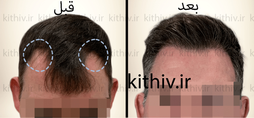 Hair transplant