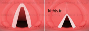 Surgical voice thinning