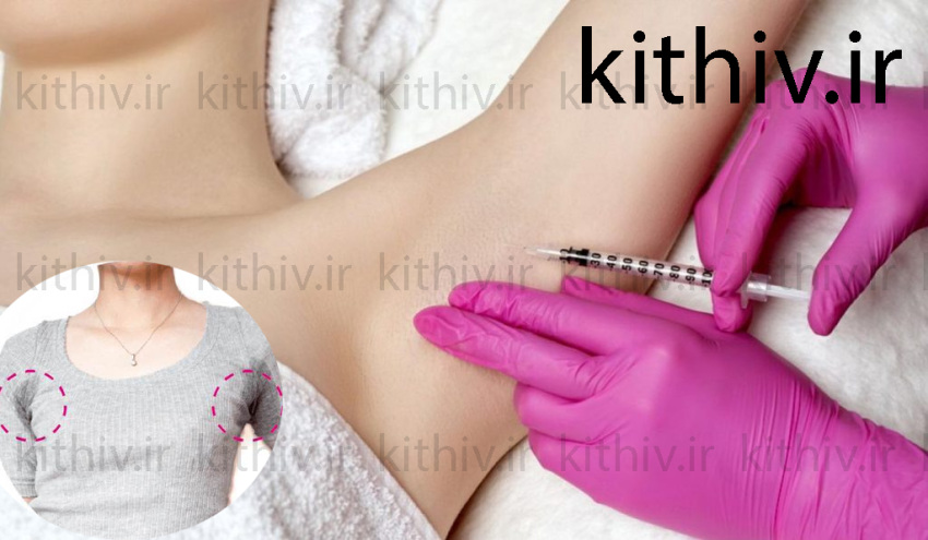 Underarm Botox to reduce sweating