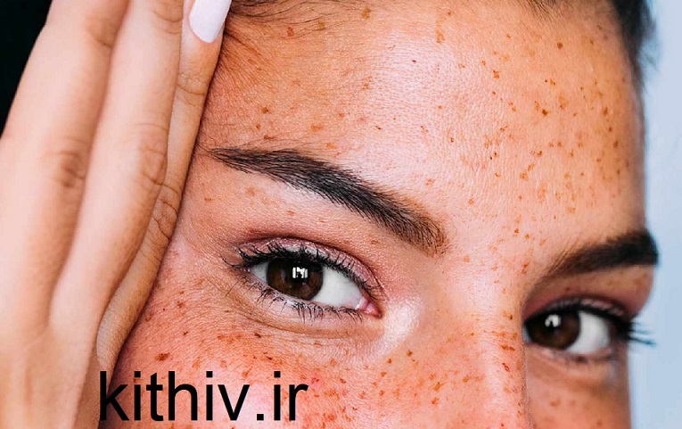 لیفت ابرو با بوتاکس