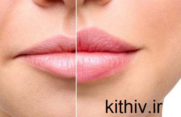 تزریق ژل لب روسی