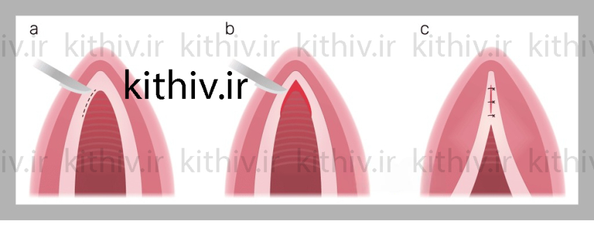روش جراحی